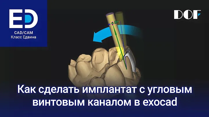 Как сделать имплантат с угловым винтовым каналом в exocad